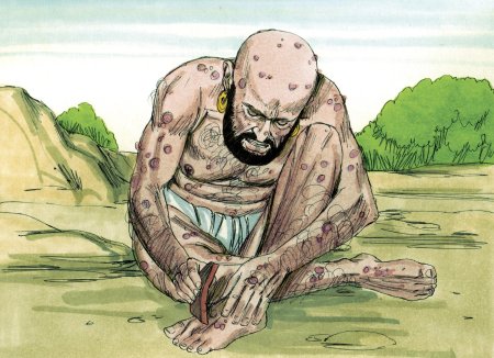 Проказа иова