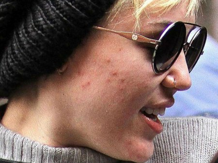 Звезды с акне