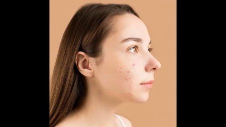 Акне у девушек