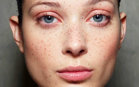 Веснушки на лице