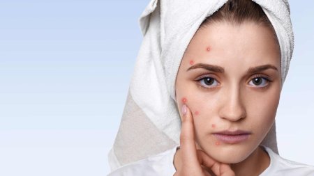 Девушка с проблемной кожей