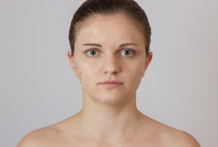 Девушка с прыщами