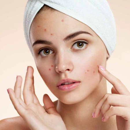 Девушка с акне