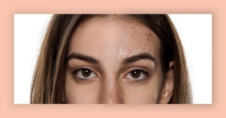 Девушка с проблемной кожей