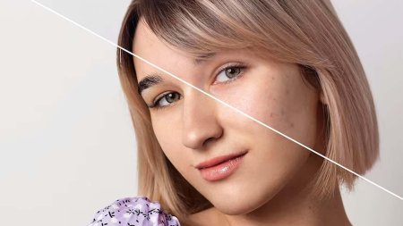 Девушка с прыщами