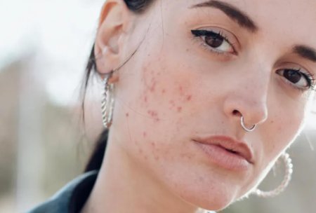Акне на коже лица