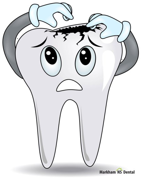 Зуб с кариесом