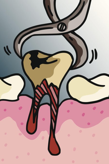 Пульпит - воспаление пульпы зуба