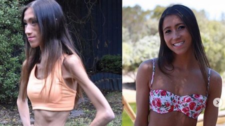 Сара анорексия