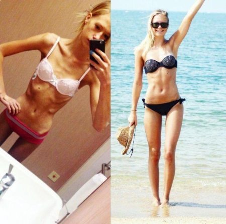 Хилькевич анна анорексия