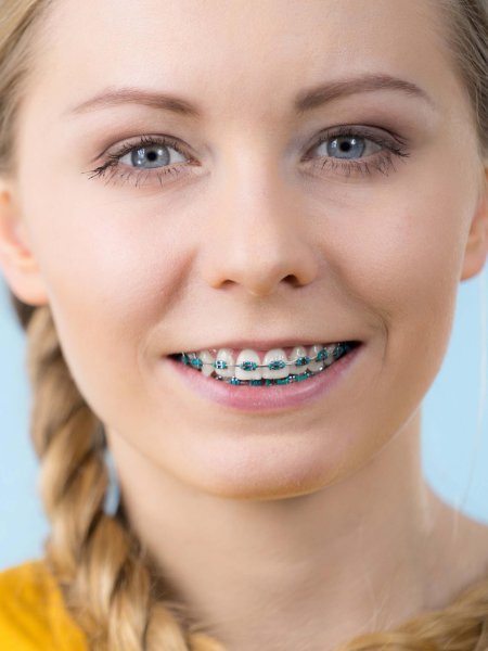 Металлические брекеты