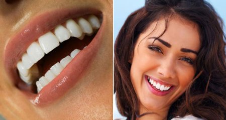 Голливудская улыбка виниры