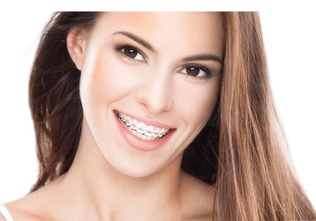 Девушки с брекетами