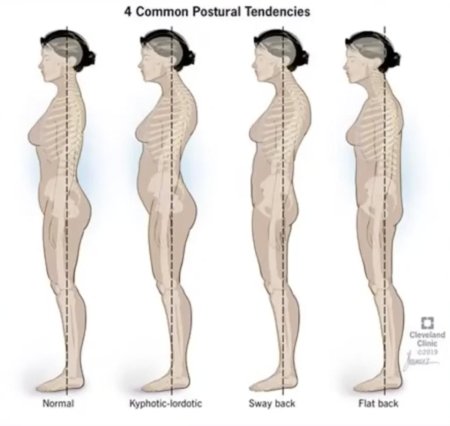 Гиперлордоз поясничного отдела норма