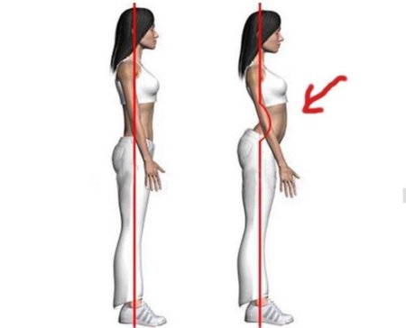 Осанка гиперлордоз