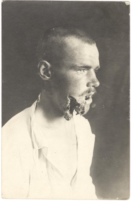 Осовец 1915 атака мертвецов