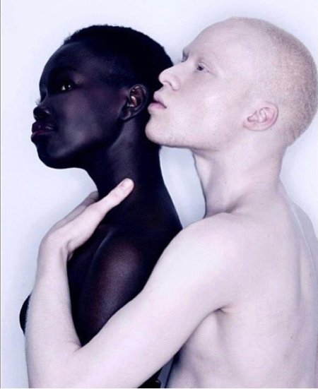 Альбинос негроидной расы