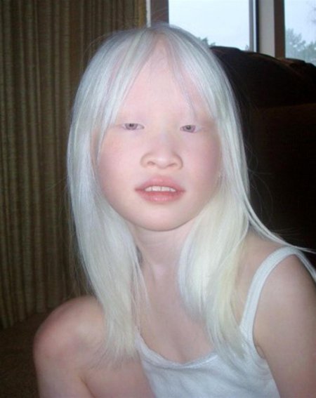 Альбинизм в