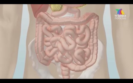 Стриктуры кишечника