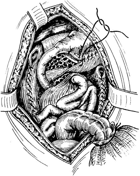 Мобилизация ободочной кишки