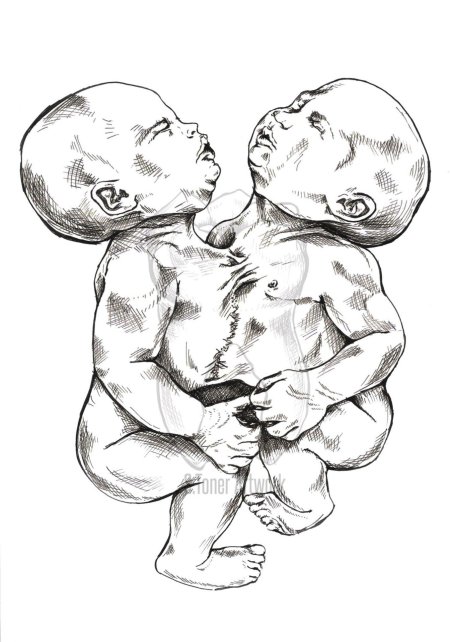 Сиамские близнецы торакопаги