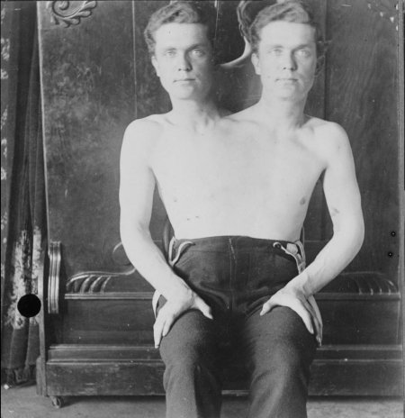 Сиамские близнецы люди