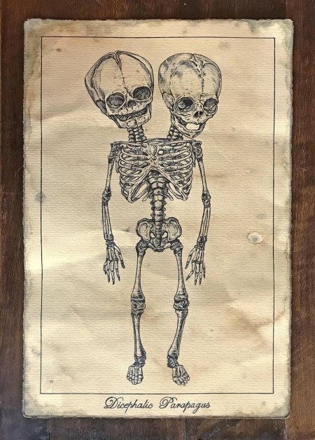 Скелет сиамских близнецов кунсткамера