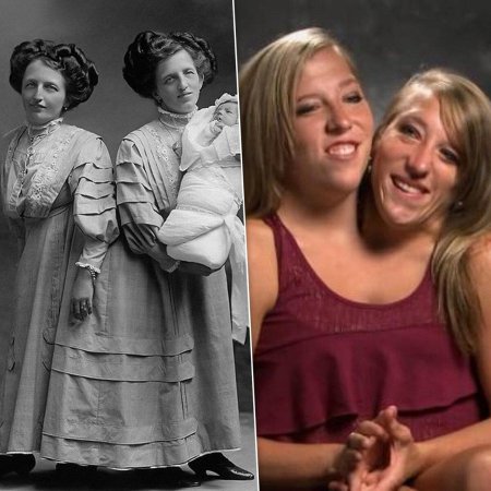 Эбби и британи сиамские близнецы