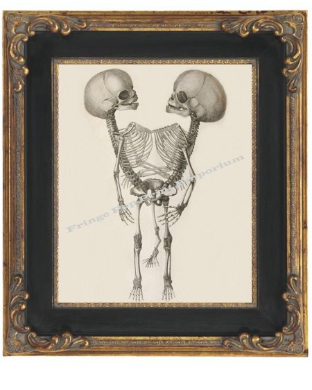 Сиамские близнецы скелет