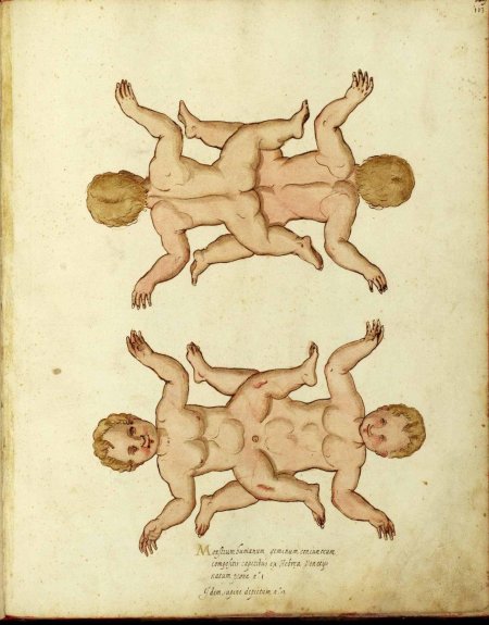 Анатомия сиамских близнецов