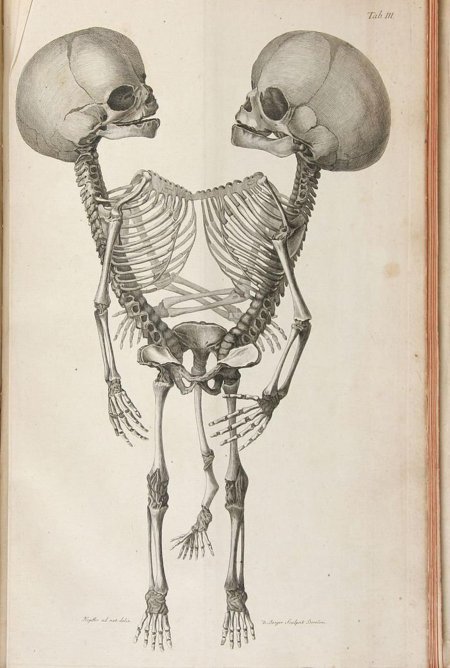 Скелет сиамских близнецов