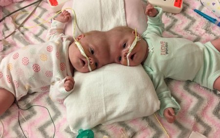 Разделенные сиамские близнецы