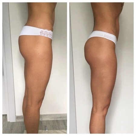 Плоские ягодицы