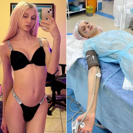 Корейка вагинопластика