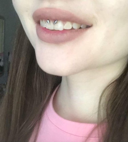 Смайл пирсинг