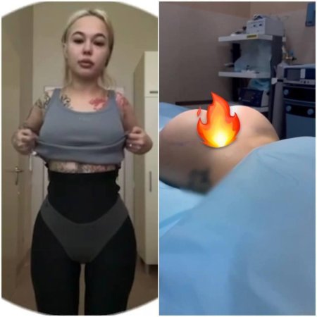 Увеличение ягодиц имплантами