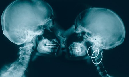 Рентгеновский снимок