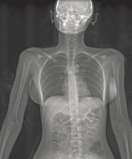 Lodox рентген