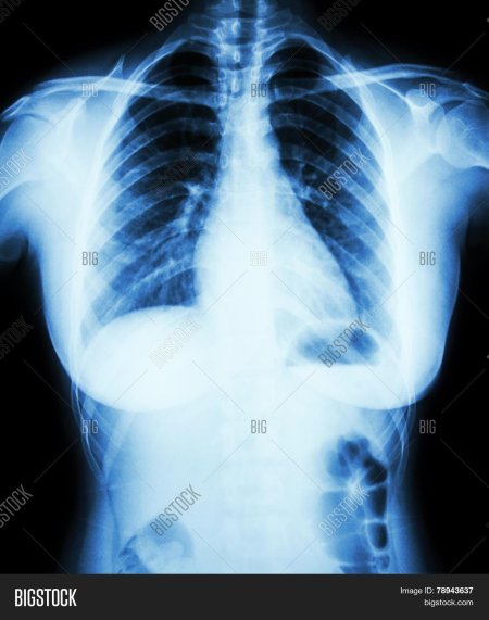 Снимок грудной клетки