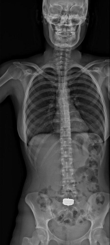 Рентгеновский снимок