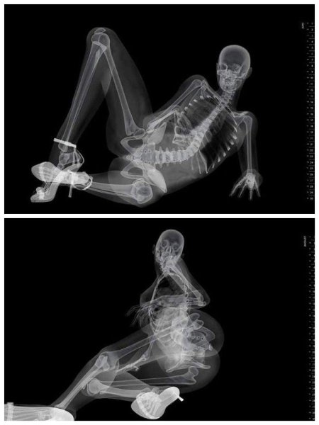 Рентгеновский снимок