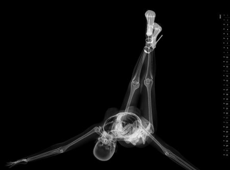 Рентгеновский снимок