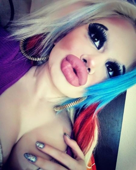 Огромные губы у девушки