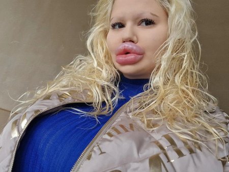 Девушка с самыми большими губами мире