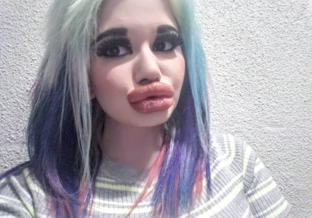 Девушка с самыми большими губами мире