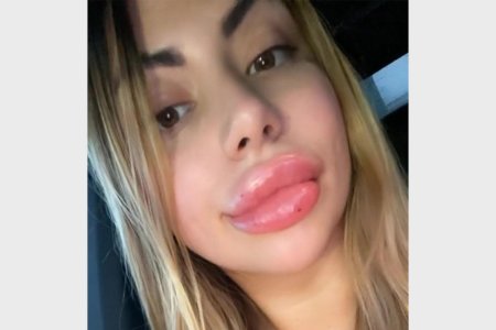 Утиные губы после увеличения