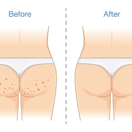 Высыпания на ягодицах у ребенка