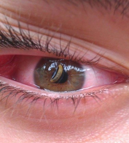 Слизистая глаз