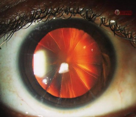 Радиальная кератотомия