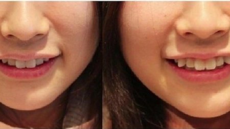 Кривые зубы у японок